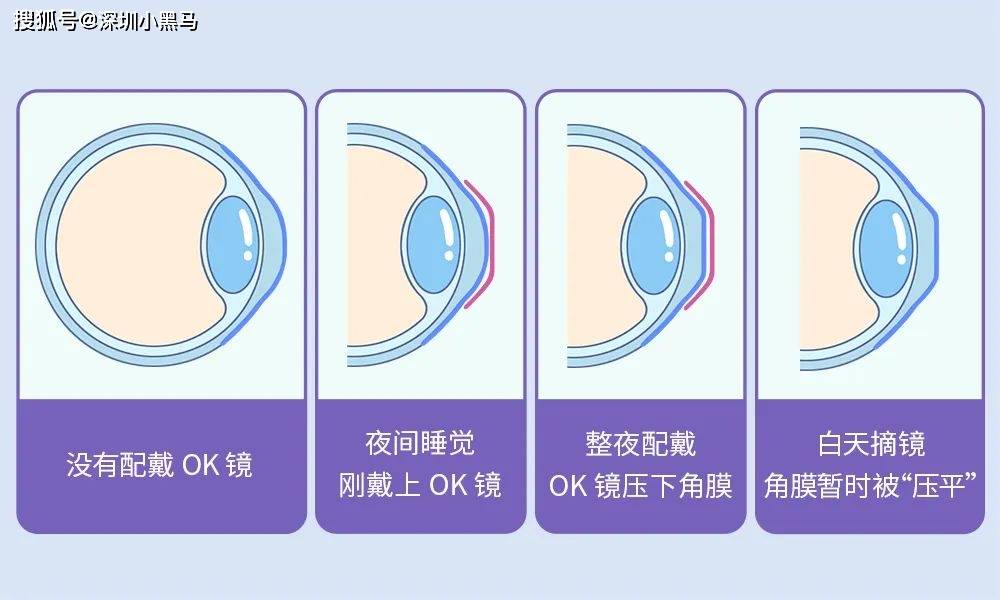 OK镜矫正视力，到底是怎么回事？
